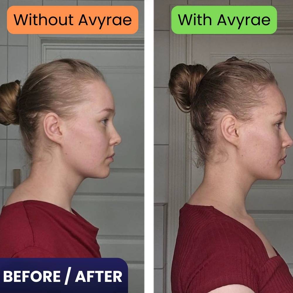 Before and after comparison of a woman's face with and without Avyrae product.