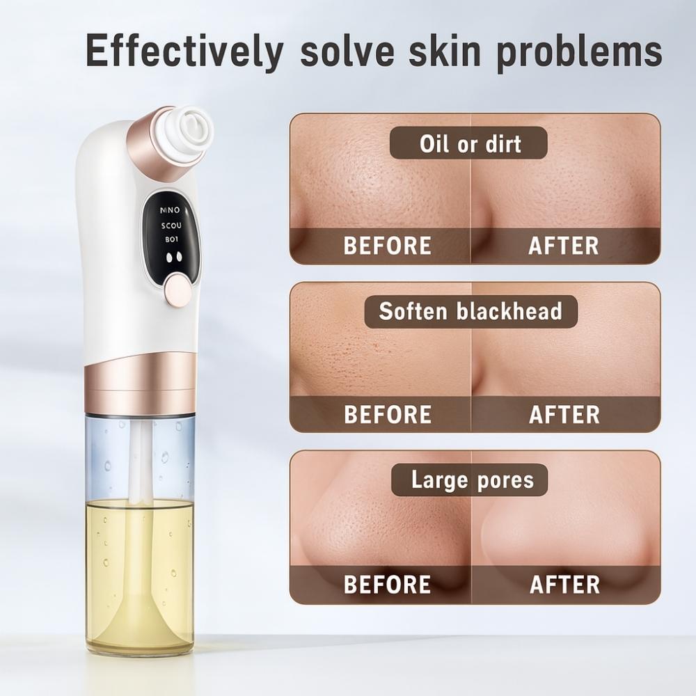 Before and after skin improvement results from Avyrae™ AquaLift Pore Vacuum showing reduced oil, blackheads, and large pores