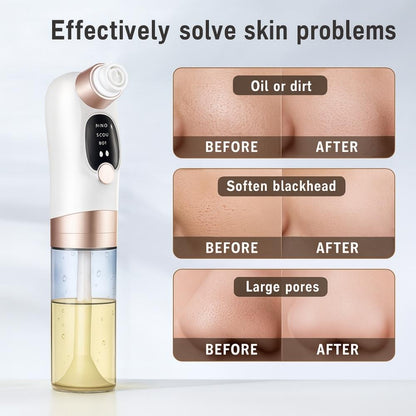 Before and after skin improvement results from Avyrae™ AquaLift Pore Vacuum showing reduced oil, blackheads, and large pores