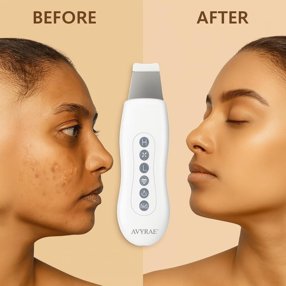 Side-by-side comparison of a woman’s skin before and after using the Avyrae™ IonLift Ultrasonic Skin Scrubber, with the product shown in the center.