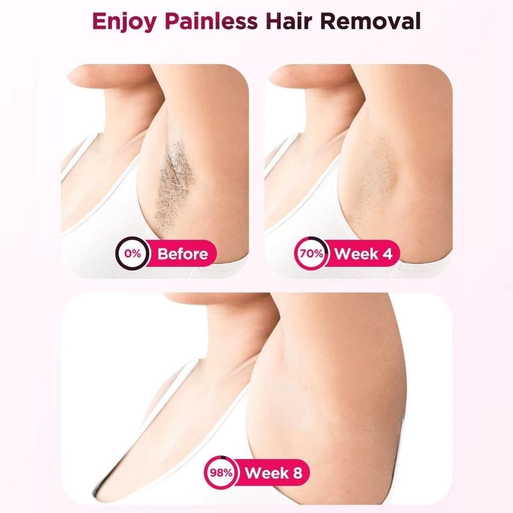 Before and after comparison of hair removal on a leg with text indicating progress over weeks.