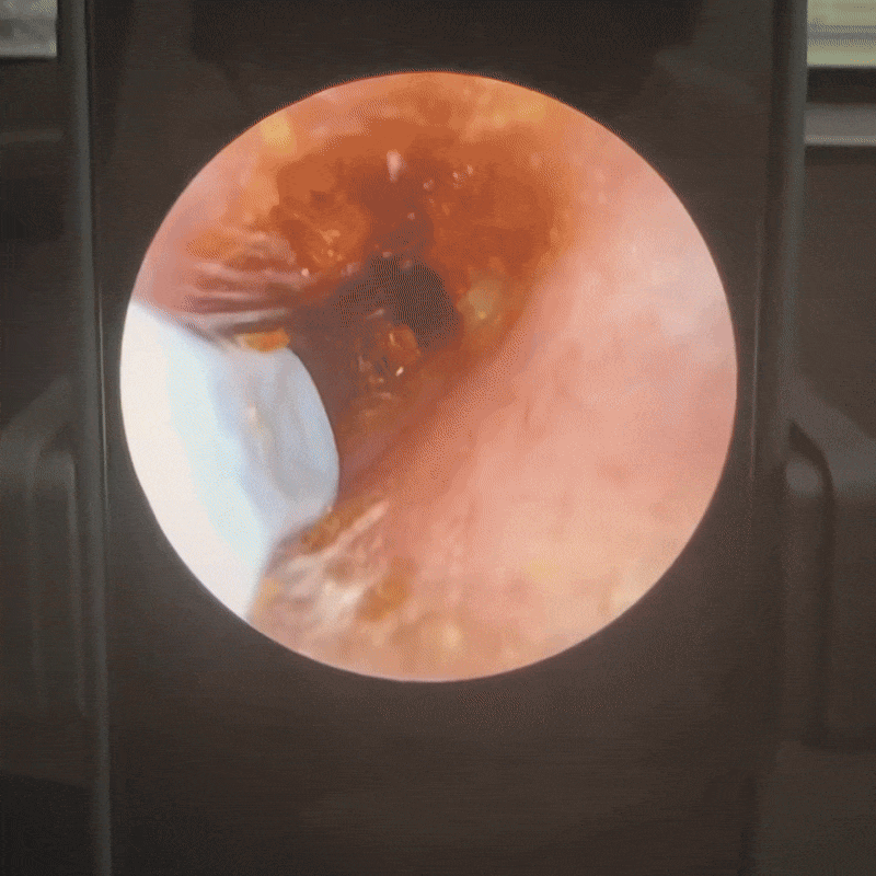 Avyrae™ Smart Ear Cleaner with HD Camera