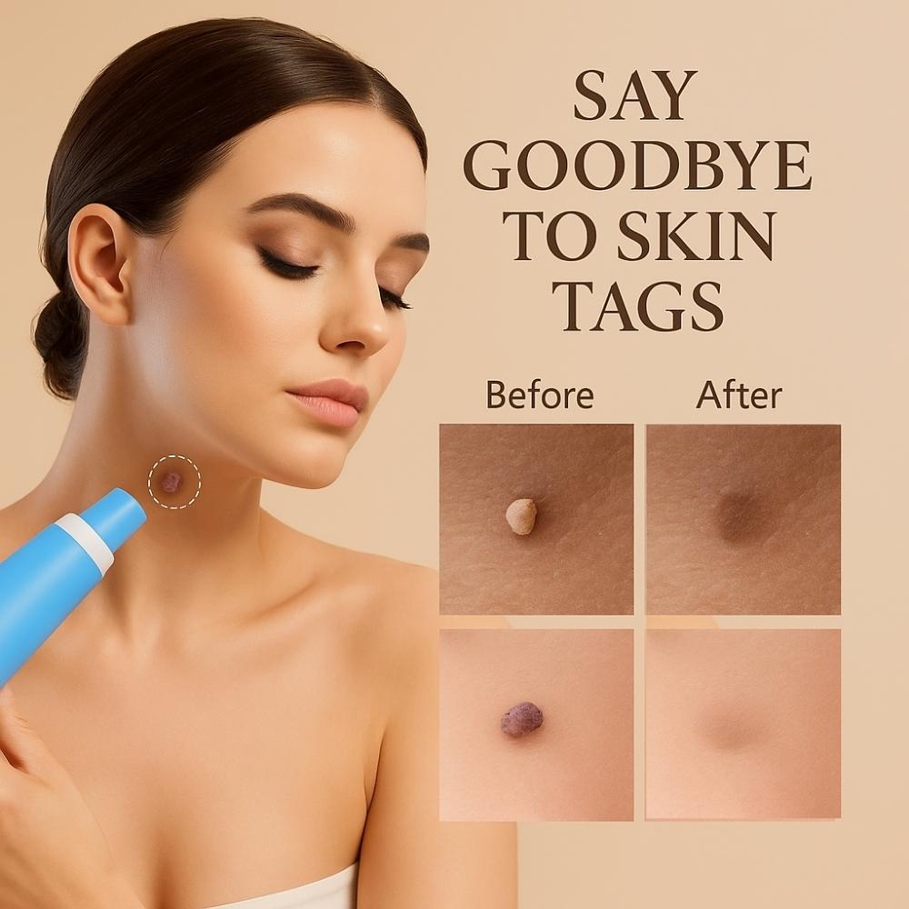 Woman using blue skin tag remover on neck with visible before-and-after skin tag treatment results.